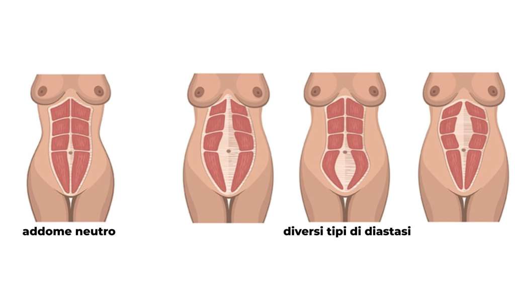 diversi tipi di diastasi addominale